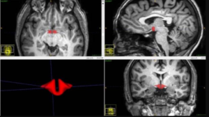 ピルが女性の脳を縮小させている可能性が最新の研究によって示される