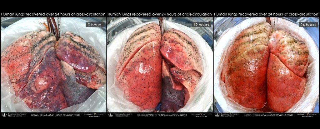 ダメージを受けた人間の肺をブタに取り付けることで修復可能であることが実験で明らかに